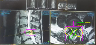 My Bifurcated Spinal Cord, MRI of herniated disc between L4-L5 lumbar spine (Kirt Blattenberger) - RF Cafe